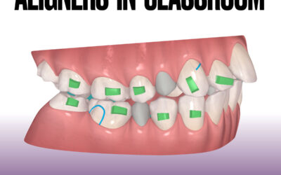 Aligners in Classroom